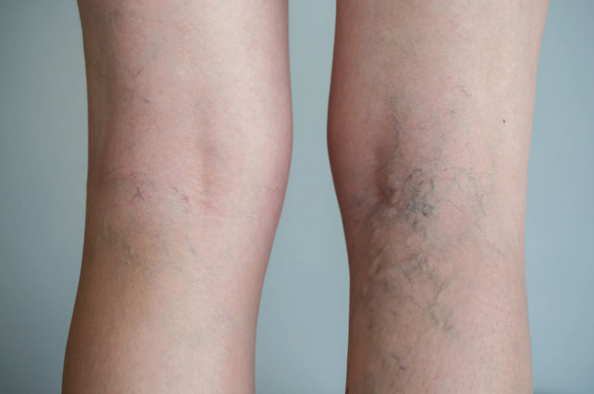 varicose veins