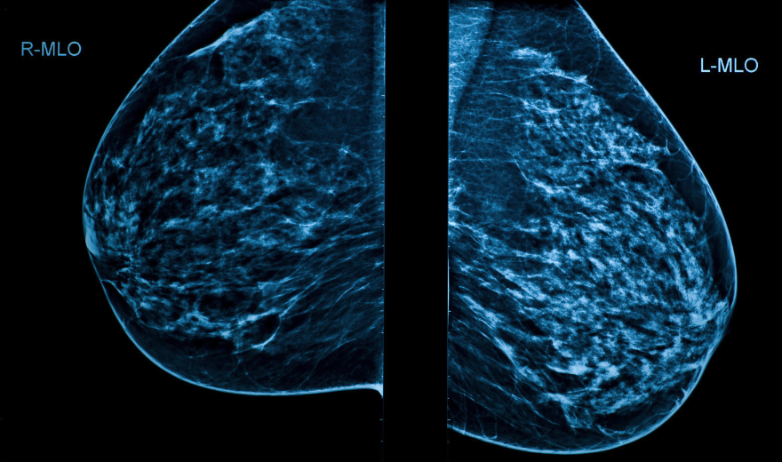mammogram what to expect